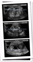 Prank Fake Ultrasound 14-15 Week Twins