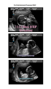 11-12 weeks strip ultrasound in 3 different pictures