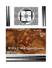 3D 10 to 17 week triplets ultrasound