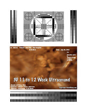3D 11 to 12 week ultrasound