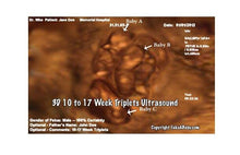 3D 10 to 17 week triplets ultrasound